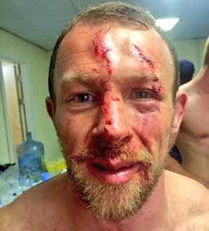 Higham posted this image of his cut face to his Twitter account shortly after the Wigan game. ©Twitter
